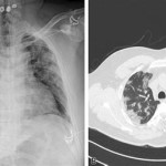 Ground Glass Opacity In Lungs Mayo Clinic