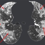 Ground Glass Opacity Lung Cancer Radiology