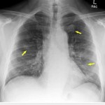 What Are Nodular Ground Glass Opacities In Lung